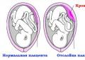 Эклампсия: причины развития и принцип лечения Эклампсия после родов у женщин лечение