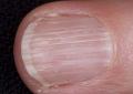 Причины дистрофии ногтя и методы лечения Гапалонихия и онихолизис